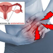 Tratamiento de Endometriosis en San Juan del Rio