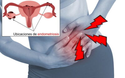 Endometriosis – Malestar Vaginal