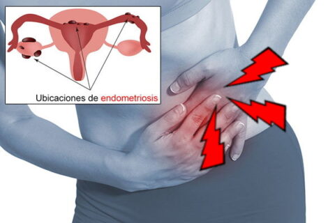 Tratamiento de Endometriosis en San Juan del Rio
