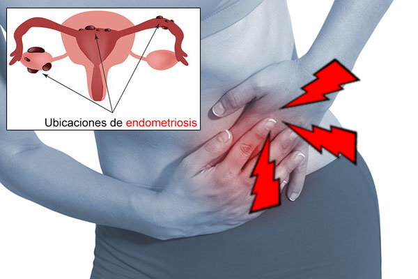 Endometriosis – Malestar Vaginal